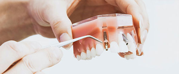 Implantes dentales en DENTALEX