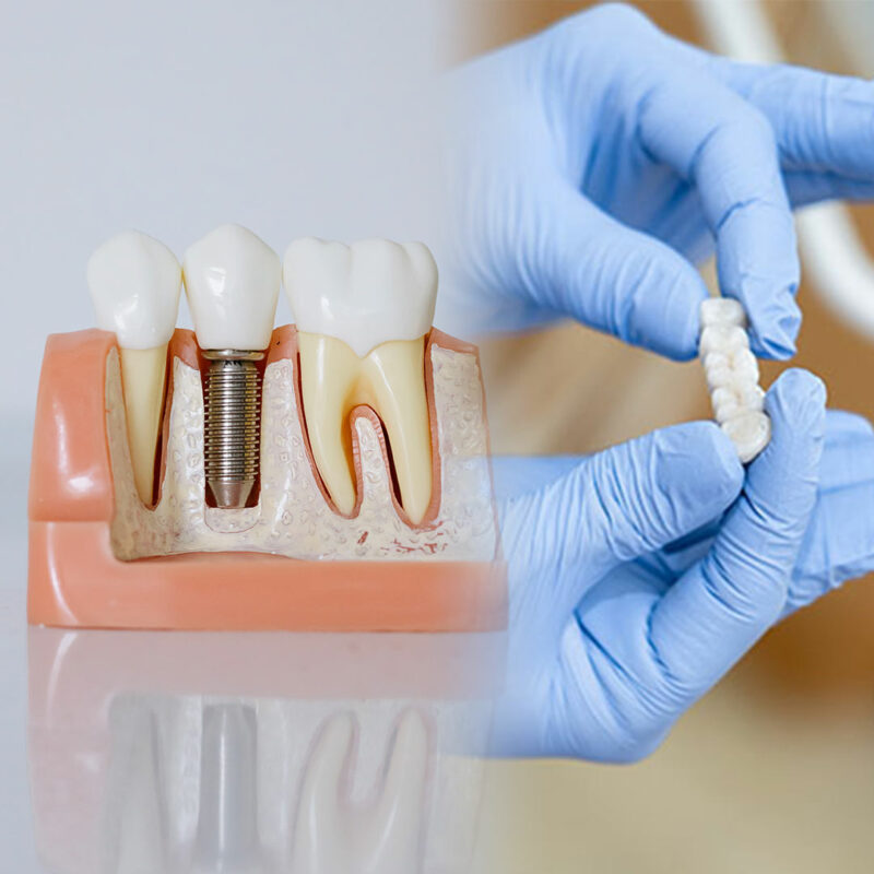 Implante o puente dental: qué te conviene más