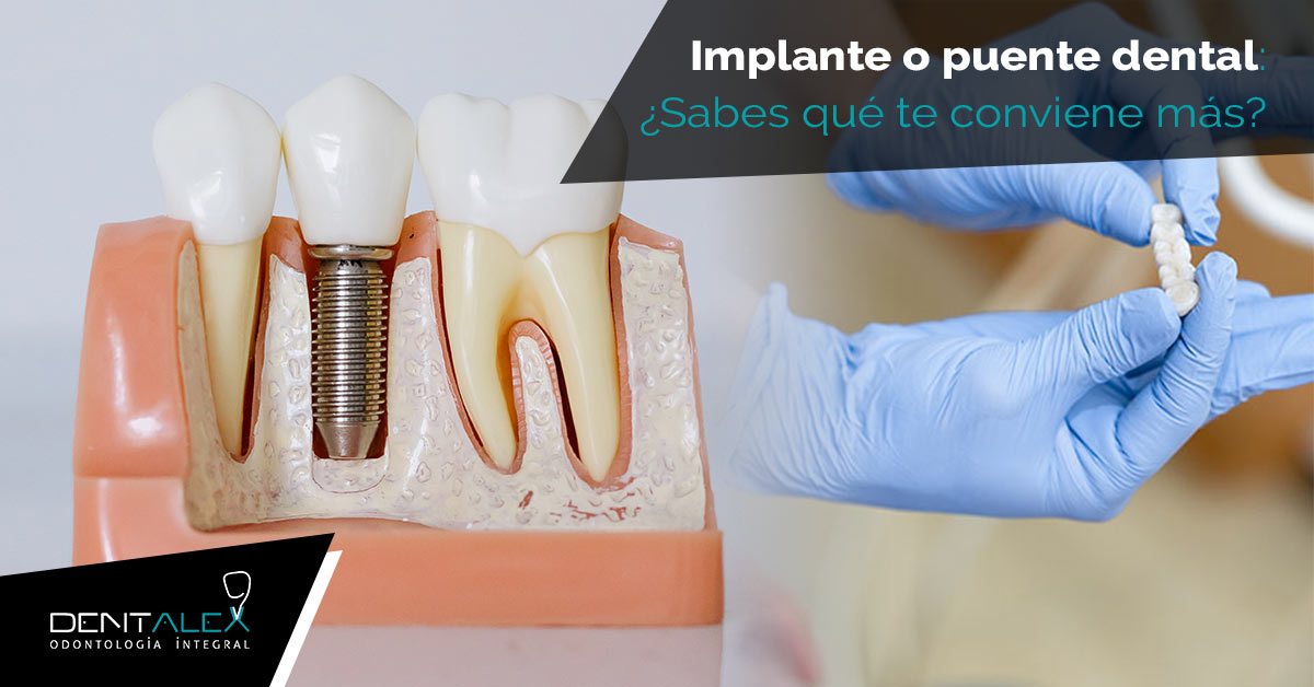 implante o puente dental