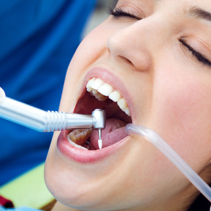 Empaste dental en Valladolid: esto es lo que necesitas saber