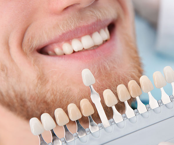 Carillas dentales en Valladolid