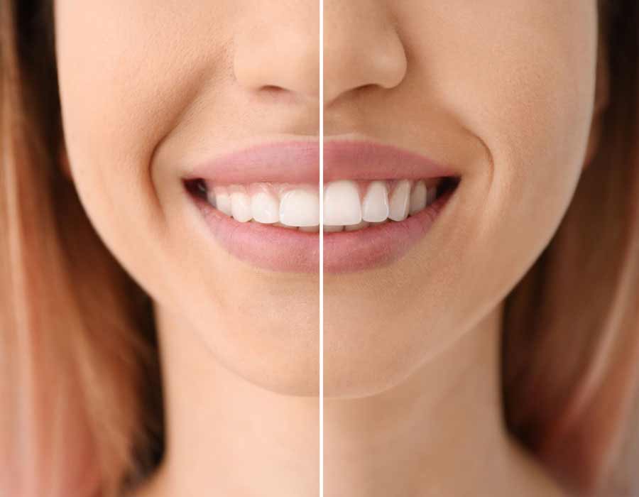 Gingivectomia en Valladolid