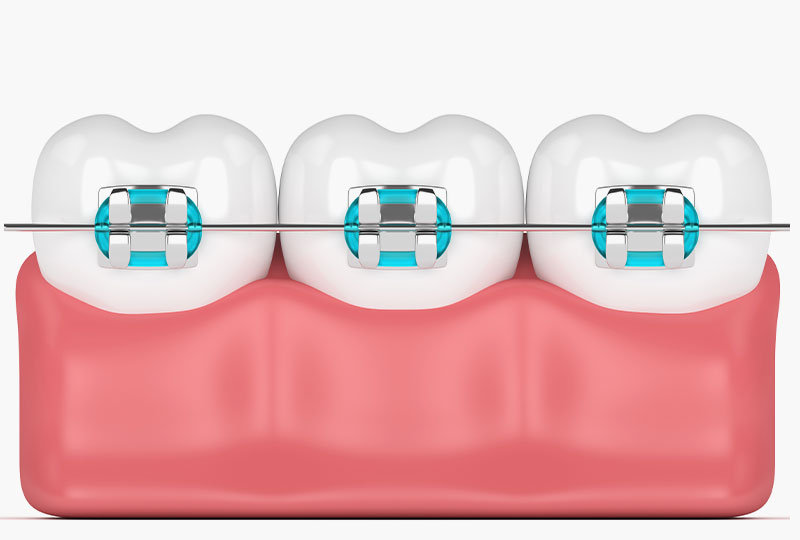 Brackets metálicos - Ortodoncia en Valladolid