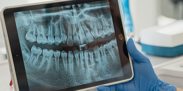 Periodontitis