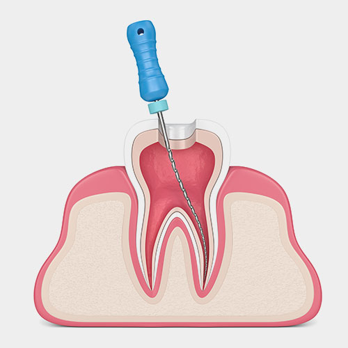 Qué es una endodoncia