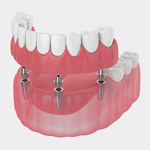 Tipos de dentadura postiza